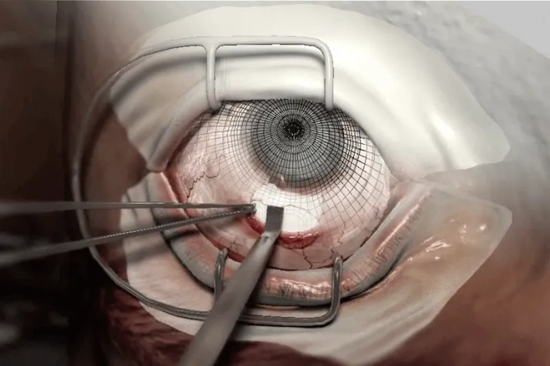 Cataract Surgery Training Simulator