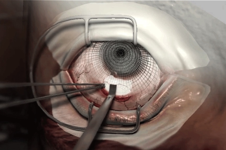 Cataract Surgery Training Simulator